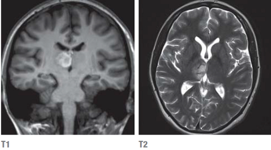 Abbildung: Magnetresonanztomographie (MRT) mit hämorrhagischem Stauungsinfarkt im rechten Thalamus bei innerer Hirnvenenthrombose.